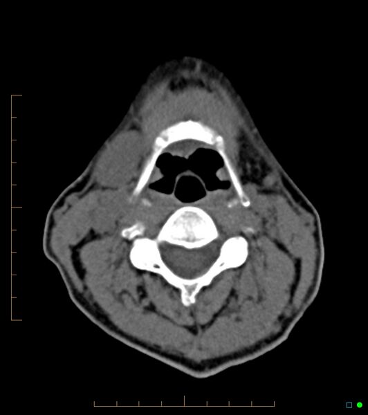 File:Chronic Submandibular sialolithiasis (Radiopaedia 16880-16606 Axial non-contrast 21).jpg