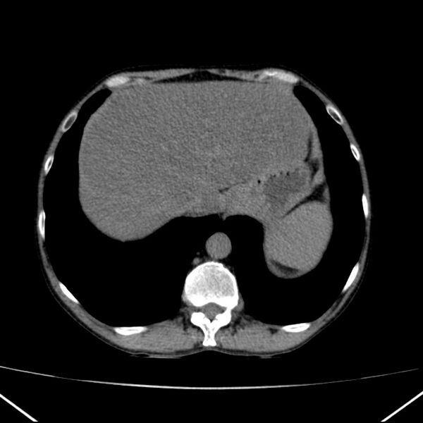 File:Chronic pancreatitis (Radiopaedia 23132-23172 Axial non-contrast 11).jpg