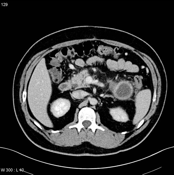 File:Chronic pancreatitis and pseudocysts (Radiopaedia 6724-7935 D 8).jpg