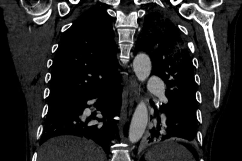File:Chronic pulmonary embolism with bubbly consolidation (Radiopaedia 91248-108850 B 95).jpg