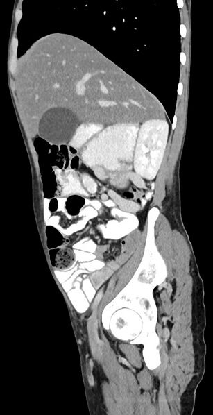 File:Chronic small bowel volvulus (Radiopaedia 75224-86322 C 105).jpg