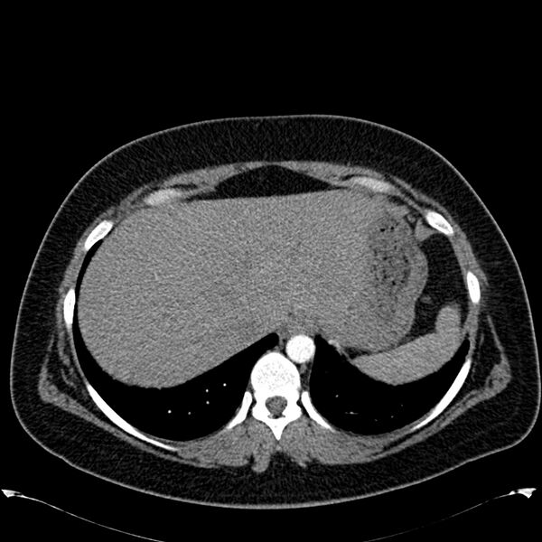 File:Chronic thromboembolic pulmonary hypertension (CTEPH) (Radiopaedia 74597-85531 Axial C+ CTPA 45).jpg