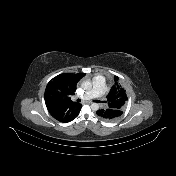 File:Chronic thromboembolic pulmonary hypertension (CTEPH) (Radiopaedia 74597-85532 Axial C+ CTPA 96).jpg