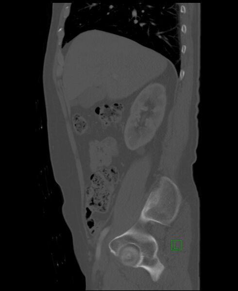 File:Clear cell renal cell carcinoma (Radiopaedia 85006-100539 Sagittal bone window 43).jpg