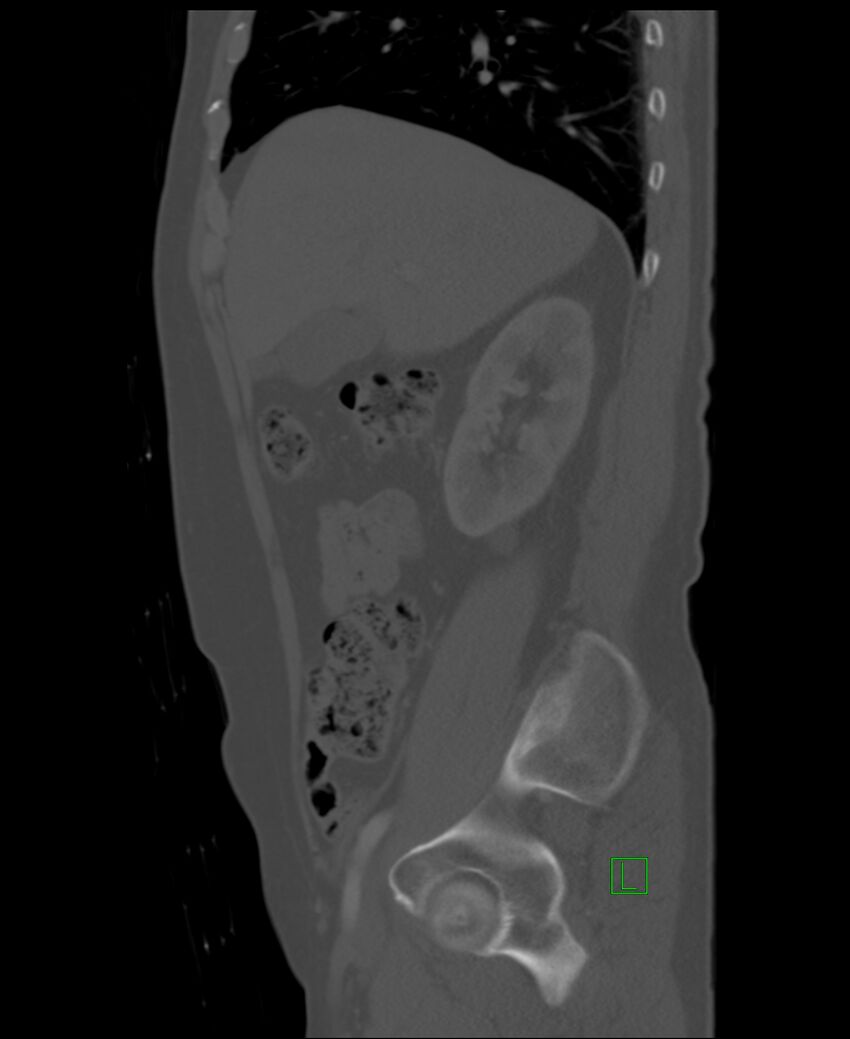 Clear cell renal cell carcinoma (Radiopaedia 85006-100539 Sagittal bone window 43).jpg