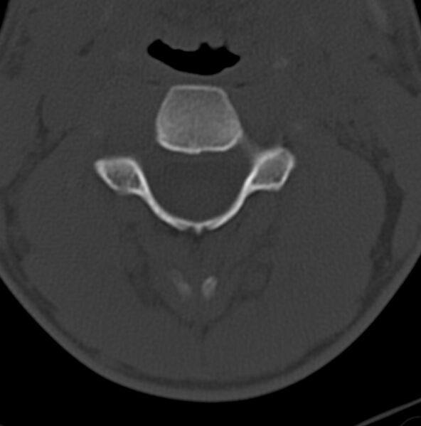 File:Cleft of the posterior arch of C1 mimicking fracture (Radiopaedia 40201-42721 Axial bone window 2).jpg