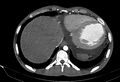 Coarctation of aorta with aortic valve stenosis (Radiopaedia 70463-80574 A 197).jpg