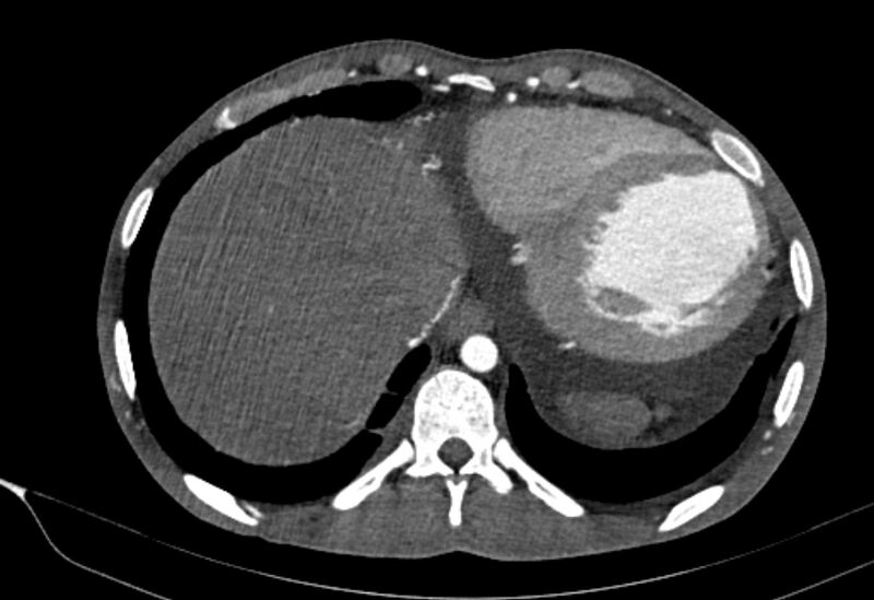File:Coarctation of aorta with aortic valve stenosis (Radiopaedia 70463-80574 A 197).jpg