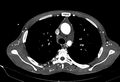 Coarctation of aorta with aortic valve stenosis (Radiopaedia 70463-80574 A 51).jpg