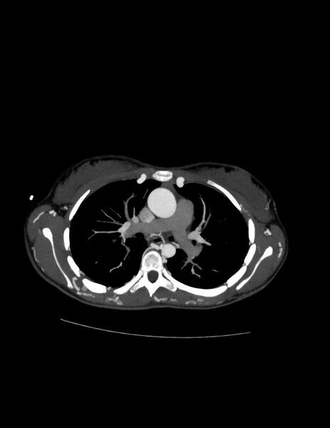 File:Coarctation of the aorta (Radiopaedia 27458-27657 D 11).jpg