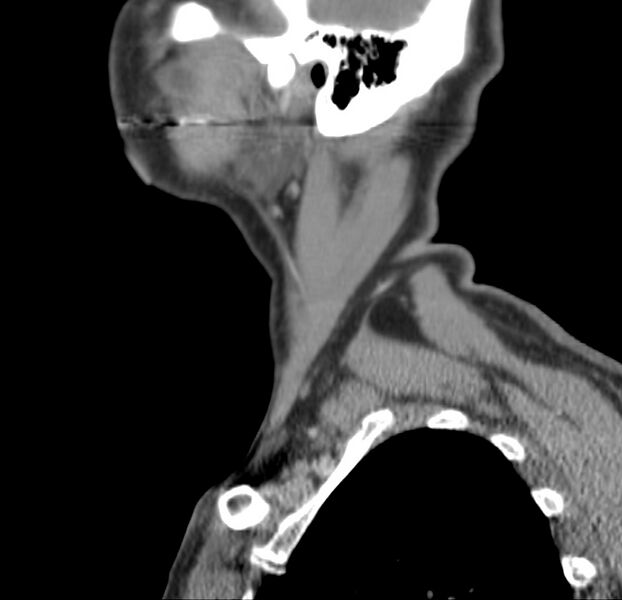 File:Colloid cyst of thyroid (Radiopaedia 22897-22923 Sagittal C+ delayed 11).jpg