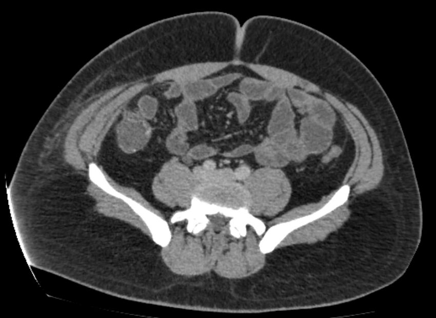 Colocutaneous fistula (Radiopaedia 56401-63062 A 60).jpg