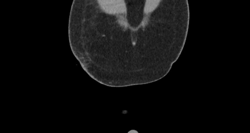 File:Colocutaneous fistula (Radiopaedia 56401-63062 C 3).jpg