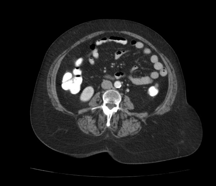 File:Colonic diverticulosis (Radiopaedia 22934-22957 A 38).jpg