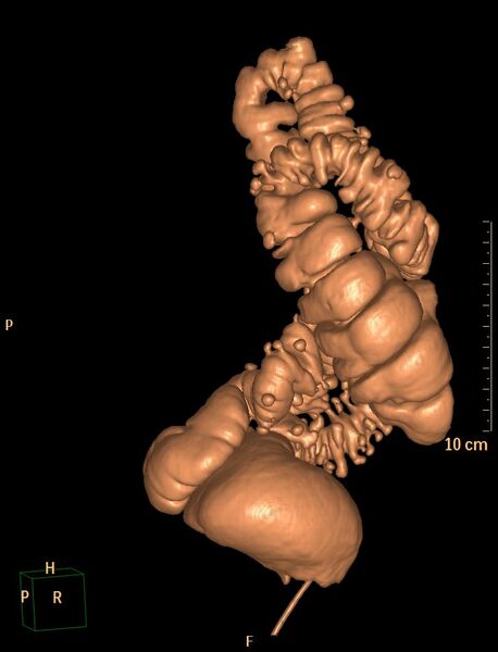 File:Colonic diverticulosis (Radiopaedia 29641-30159 3D VC 7).jpg