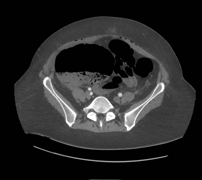 File:Colonic pseudo-obstruction (Radiopaedia 79752-92980 A 134).png