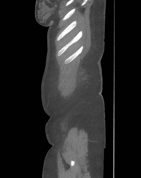 File:Colonic pseudo-obstruction (Radiopaedia 79752-92980 C 9).png