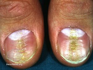Median canaliform nail dystrophy (DermNet NZ median).jpg