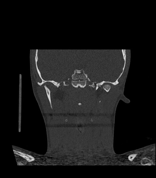 File:Nasoorbitoethmoid fracture (Radiopaedia 90044-107205 Coronal bone window 91).jpg