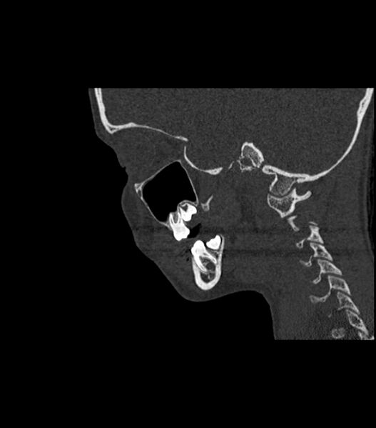 File:Nasoorbitoethmoid fracture (Radiopaedia 90044-107205 Sagittal bone window 52).jpg