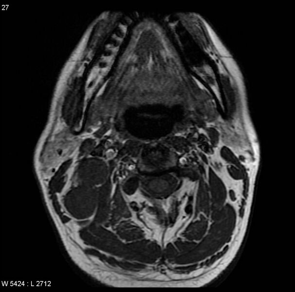 File:Nasopharyngeal carcinoma (Radiopaedia 4546-6667 Axial T1 16).jpg