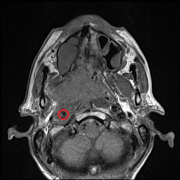 File:Nasopharyngeal carcinoma with skull base invasion (Radiopaedia 59258-66624 A 1).jpeg