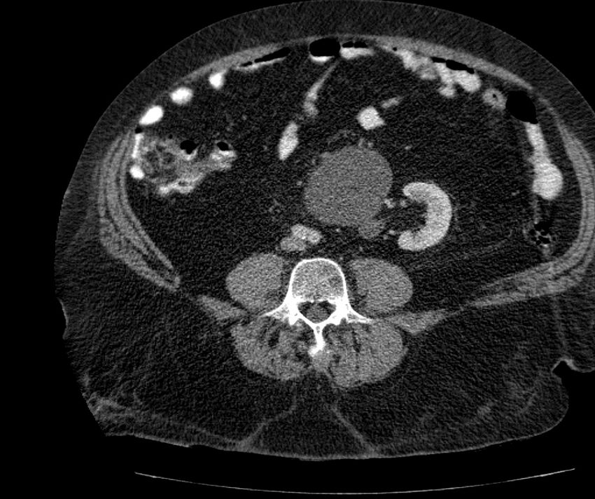 Nephroptosis with inguinal hernia containing perirenal fat (Radiopaedia 56632-63391 C 212).jpg