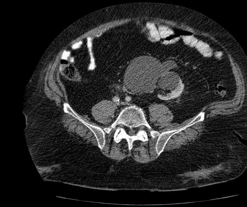Nephroptosis with inguinal hernia containing perirenal fat (Radiopaedia 56632-63391 C 235).jpg