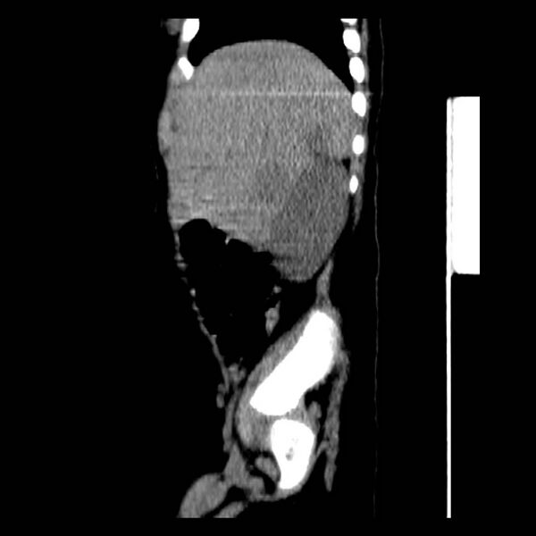 File:Neuroblastoma with skull metastases (Radiopaedia 30326-30960 B 9).jpg