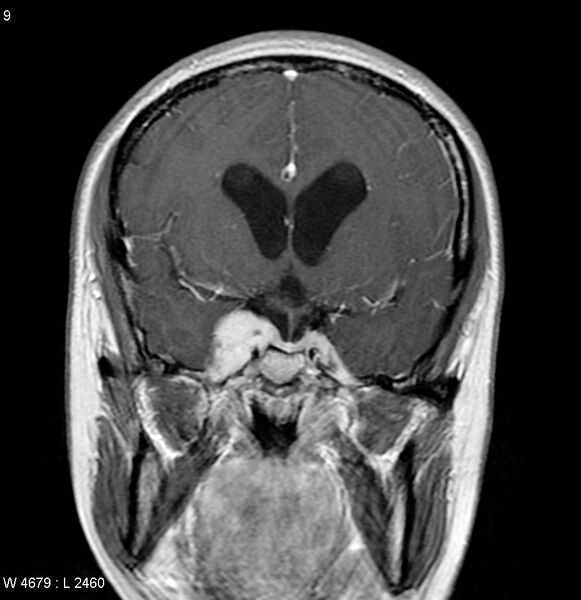 File:Neurofibromatosis type 2 - cranial and spinal involvement (Radiopaedia 5351-7111 Coronal T1 C+ 2).jpg