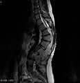 Neurofibromatosis type 2 - cranial and spinal involvement (Radiopaedia 5351-7112 B 8).jpg