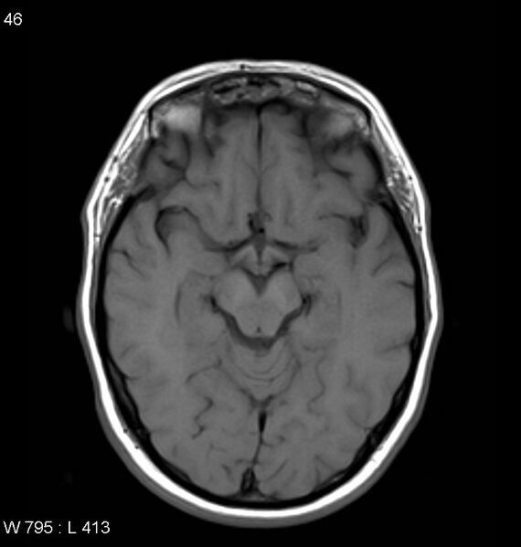 File:Neurosarcoidosis (Radiopaedia 10930-11351 Axial T1 8).jpg