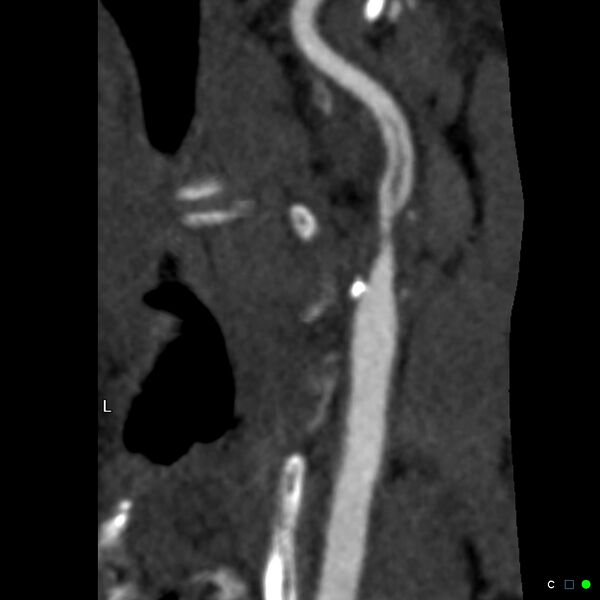 File:Non-occlusive intraluminal internal carotid artery thrombus (Radiopaedia 37751-39658 A 40).jpg