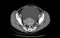 Non-puerperal uterine inversion (Radiopaedia 78343-91094 A 20).jpg