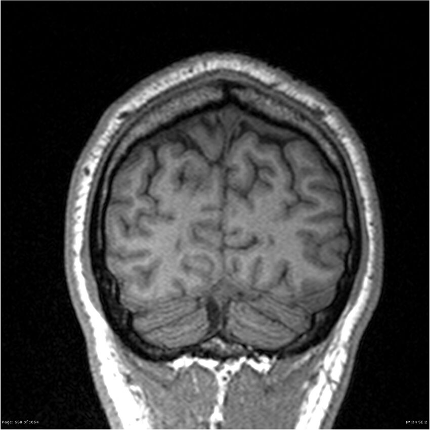 Normal brain MRI (non-focal epilepsy protocol) (Radiopaedia 38571-40700 Coronal T1 16).jpg