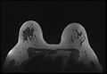 Normal breast MRI - dense breasts (Radiopaedia 80454-93850 Axial T1 157).jpg