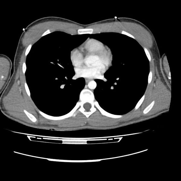 File:Normal dual-phase trauma CT chest,abdomen and pelvis (Radiopaedia 48092-52899 A 31).jpg