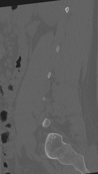 File:Normal lumbar spine CT (Radiopaedia 46533-50986 Sagittal bone window 27).png