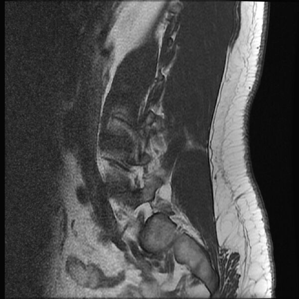 File:Normal lumbar spine MRI (Radiopaedia 43051-46311 Sagittal T1 17).jpg