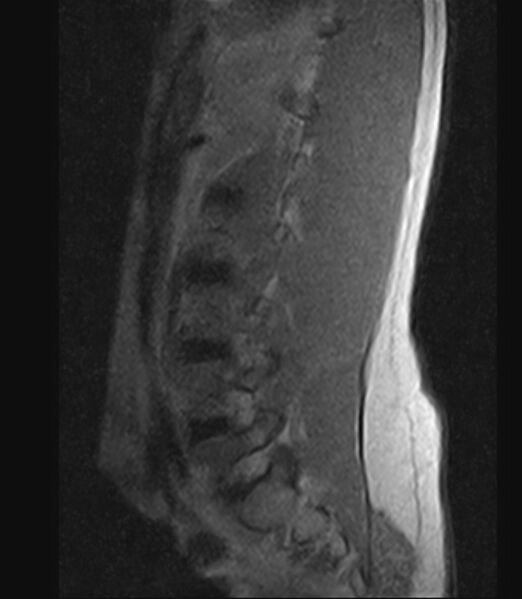 File:Normal lumbar spine MRI - low-field MRI scanner (Radiopaedia 40976-43699 Sagittal T1 2).jpg