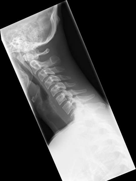 File:Normal trauma cervical spine (Radiopaedia 41017-43761 B 1).png