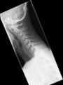 Normal trauma cervical spine (Radiopaedia 41017-43761 B 1).png