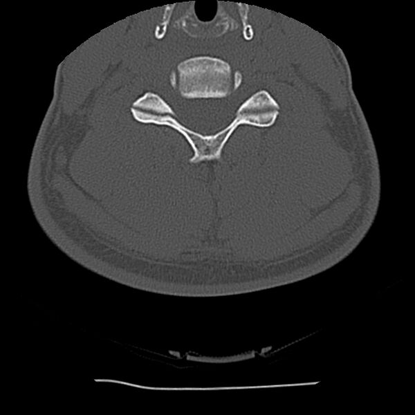 File:Normal trauma spine imaging (Radiopaedia 31753-32686 Axial bone window 51).jpg