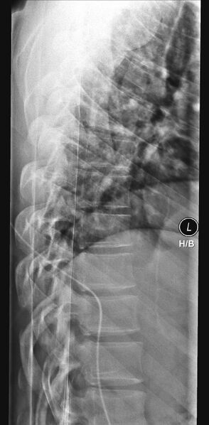 File:Normal trauma spine imaging (Radiopaedia 31753-32687 Lateral 1).jpg