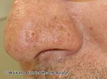Sebaceous adenoma in patient with Lynch syndrome (DermNet NZ sebaceous-adenoma).jpg