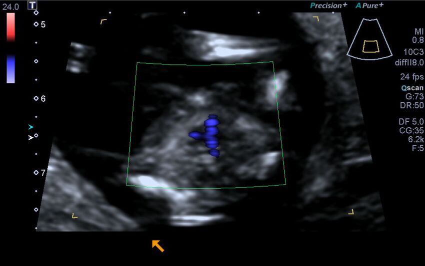 1st trimester nuchal-morphology ultrasound (Radiopaedia 44706-48477 Heart views cine with colour 171).jpg