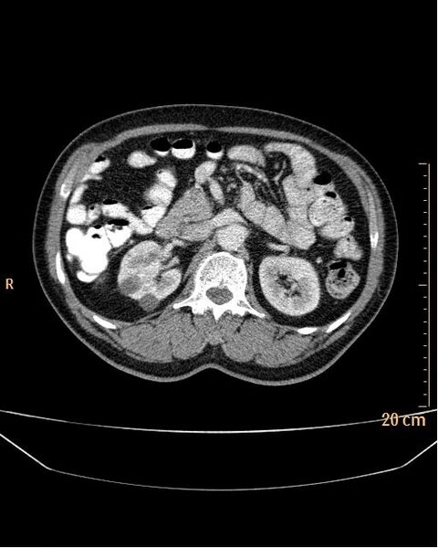 File:Abdominal aortic aneurysm (Radiopaedia 25985-26121 Axial C+ arterial phase 7).jpg