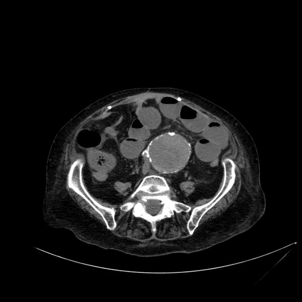 File:Abdominal aortic aneurysm - impending rupture (Radiopaedia 19233-19246 Axial non-contrast 84).jpg