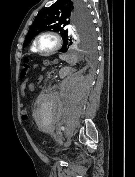 File:Abdominal aortic aneurysm rupture (Radiopaedia 54179-60362 Sagittal C+ arterial phase 29).jpg