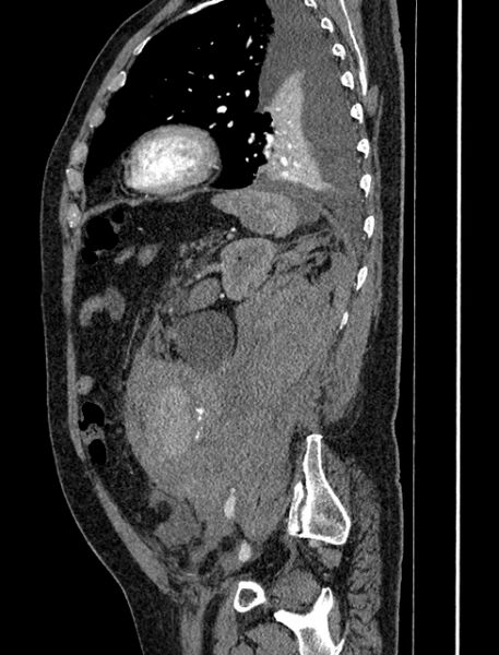 File:Abdominal aortic aneurysm rupture (Radiopaedia 54179-60362 Sagittal C+ arterial phase 31).jpg